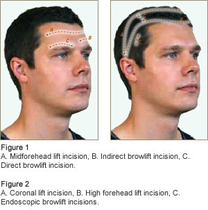 forehead brow surgery